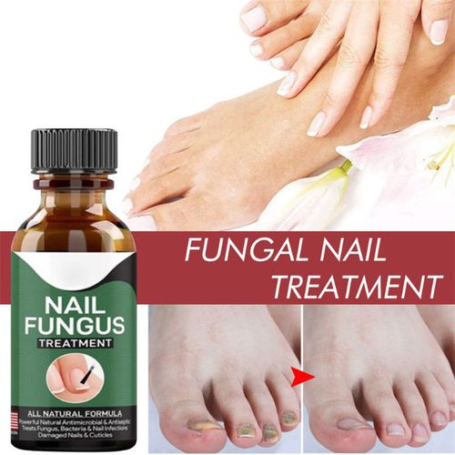 Flipdeals™  Foot Nail Fungus Removal Gel Paronychia Onychomycosis